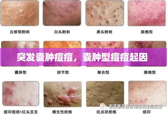 突发囊肿痘痘,囊肿型痘痘起因